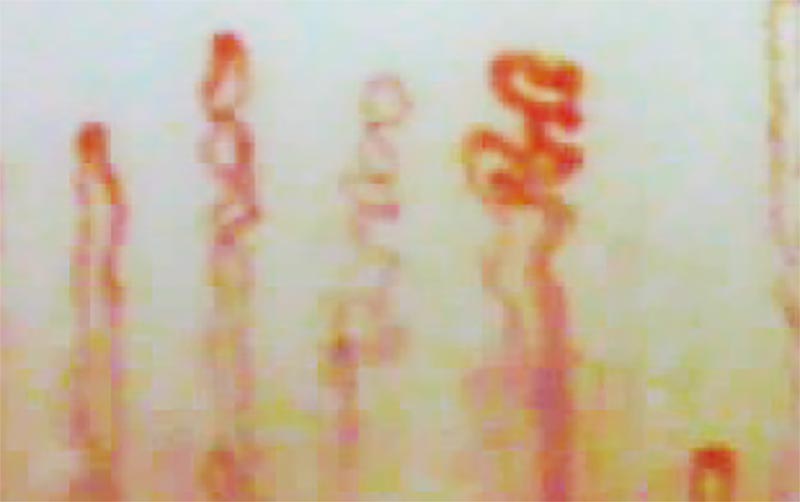 Unhealthy capillaries due to a disorderly lifestyle